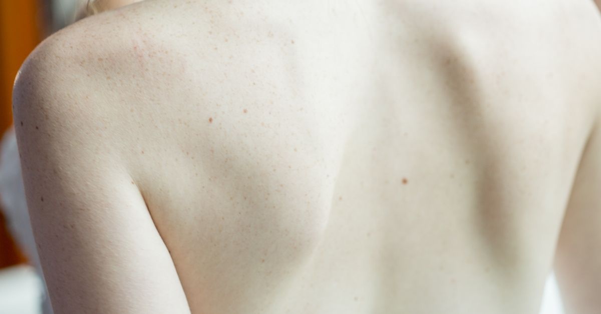 Schiena Libera dai Brufoli: la Skincare Intelligente per Dire Addio all’Acne
